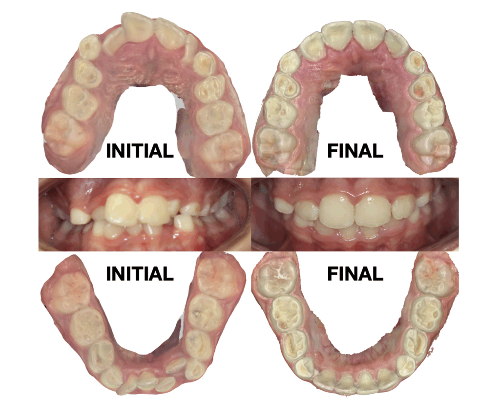 Too complex for Invisalign?